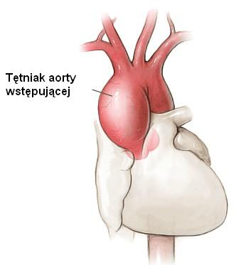tętniak aorty wstępującej